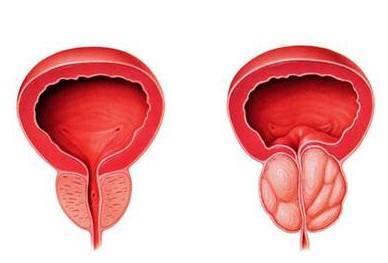 前列腺是哪里 前列腺是哪里的部位