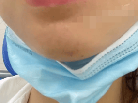 女子睡梦中被蜈蚣咬成香肠嘴 疼得超乎想象！