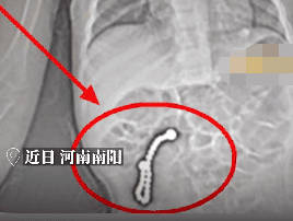2岁女童误吞23颗磁力珠 医生：随时可能发生肠穿孔！